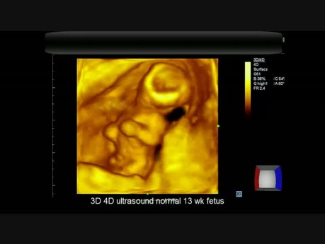 3D 4D Ultrasound Normal 13 wk Fetus