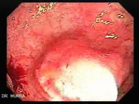 Multiple Rectal Ulcers (6 of 110)