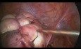 Laproscopic Myomectomy to Save Uterus in Case Of Big Multiple Fibroid