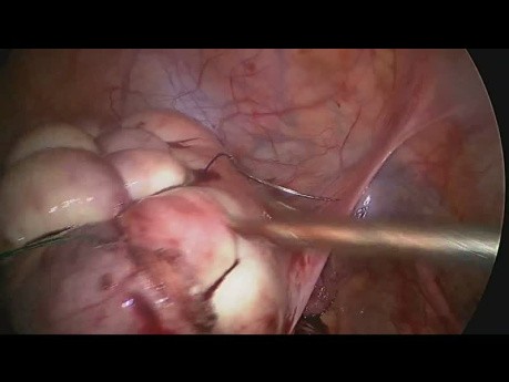 Laproscopic Myomectomy to Save Uterus in Case Of Big Multiple Fibroid