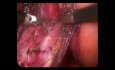 Dissection of the Vesicouterine and Vesicovaginal Spaces