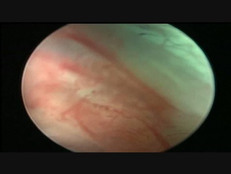 Salpingoscopy