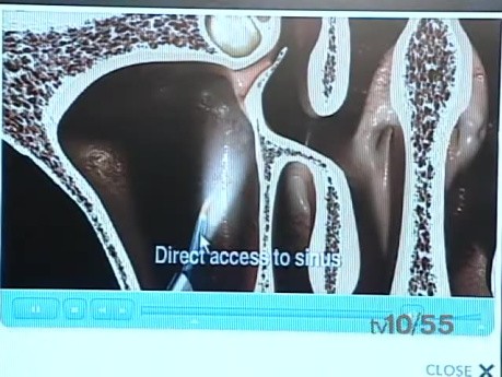 Minimally Invasive Sinus Surgery - Interview with a Surgeon