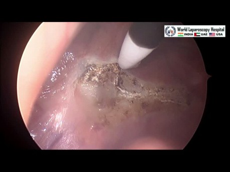 Thoracic Sympathectomy for Palmar Hyperhidrosis
