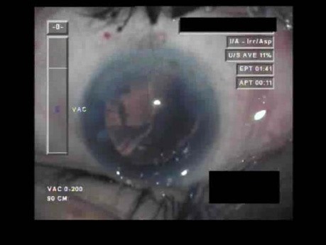 Cataract Surgery V - Part 4