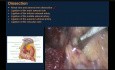 Laparoscopic Left Adrenalectomy for Large Pheocromocytoma with Operative Steps