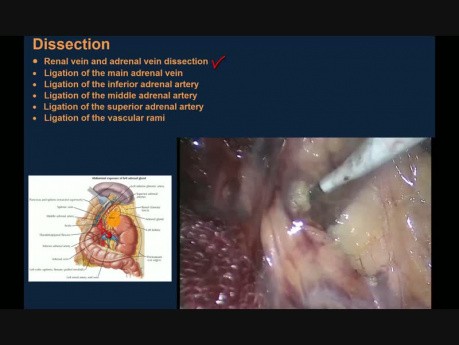 Laparoscopic Left Adrenalectomy for Large Pheocromocytoma with Operative Steps