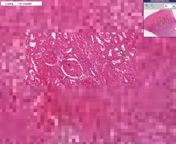 Diffuse Cortical Necrosis