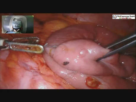 Robotic Roux-en-Y Hepaticojejunostomy in a Post-cholecystectomy Bile Duct Injury
