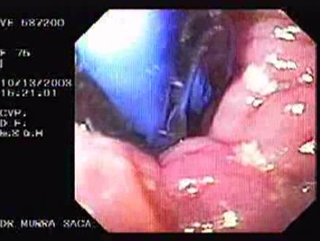Forceful Maneuver As a Treatment for Achalasia
