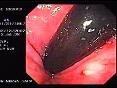 Rectal Amebiasis (2 of 2)