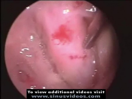 Eustachian Tuboplasty