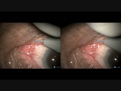 Opening a Blocked Canaliculus with Fugo Blade