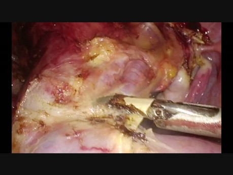 Day Care Hysterectomy