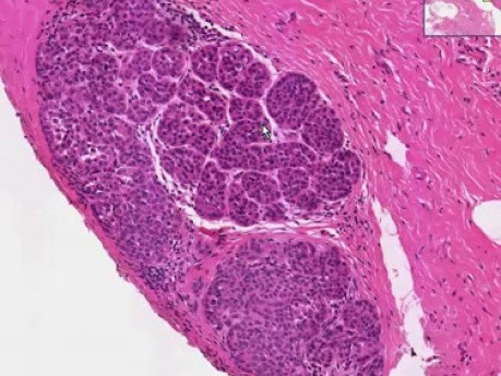 Lobular carcinoma in situ - Histopathology - Breast