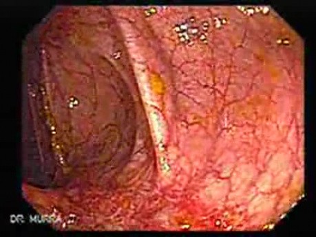 Colonic Lymphoma (4 of 6)