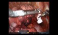 Robotic Middle Lobectomy of Lung