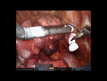 Robotic Middle Lobectomy of Lung