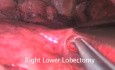 Uniportal VATS Lobectomy Lung Cancer