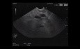 Endoscopic Ultrasound of a Common Bile Duct Stricture