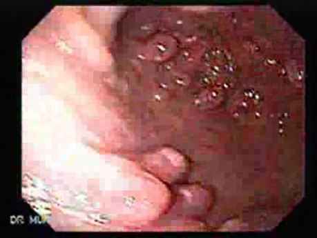 Gastric Polyposis - Endoscopy (3 of 11)