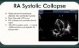 Overview of Echocardiographic Assessment of Pericardial Disease