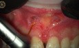 Apicoectomy With Erbium Laser Without Sutures 