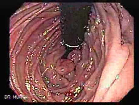 Gastric Lymphoma with Metastases to the Duodenum - Retroflexed View at the Duodenum, Part 2