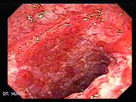 Colonic Lymphoma (2 of 6)
