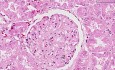 Systemic lupus erythematosus - Histopathology - Kidney