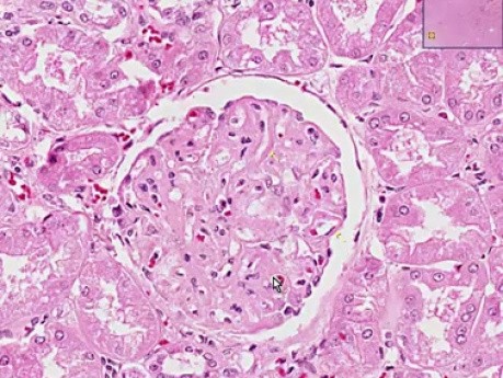 Systemic lupus erythematosus - Histopathology - Kidney