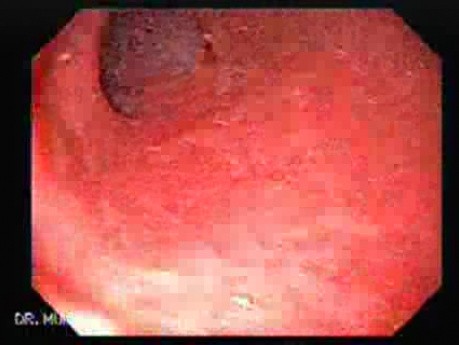 Ileal Neobladder Substitution (ileal bladder) (1 of 9)