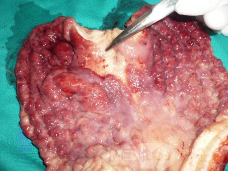 Endoscopy of Scirrhous Gastric Carcinoma involving the entire Fundus, Body and the Antrum (31 of 47)