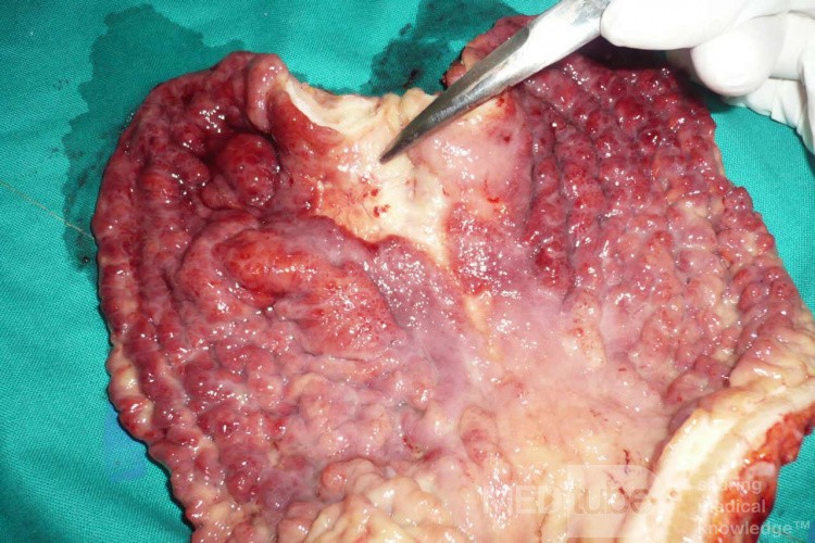 Endoscopy of Scirrhous Gastric Carcinoma involving the entire Fundus, Body and the Antrum (31 of 47)
