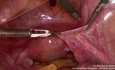 Ovarian Transposition for Cervical Cancer