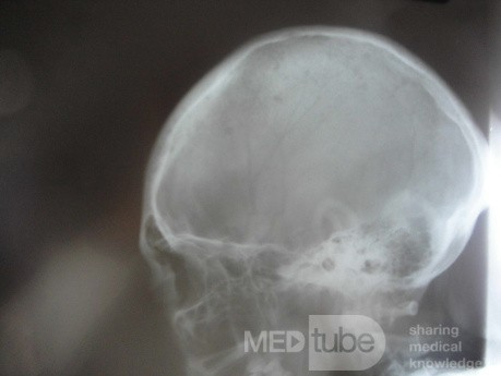 Colon Angiodysplasia and Multiple Myeloma (20 of 24)