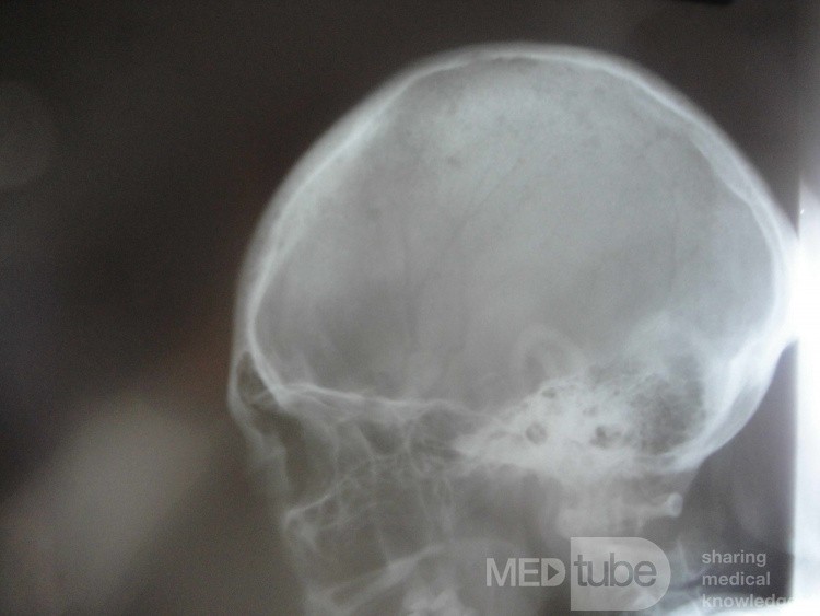Colon Angiodysplasia and Multiple Myeloma (20 of 24)