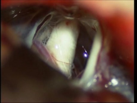 Trigeminal Neuralgia - Microvascular Decompression