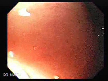Multiple Duodenal Erosions due to Salmonella Enteritis (1 of 5)
