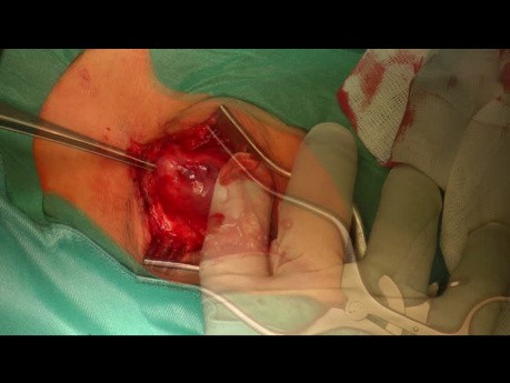 Neuroma of the Peroneal Nerve