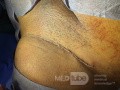 Huge Leiomyoma Uteri