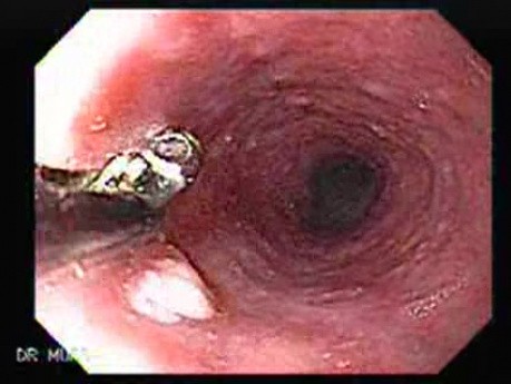Esophageal Papilloma - Endoscopic Examination