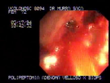 Video Colonoscopic view of a polypectomy of a big 6 cm. x 4 cm. sessile lesion (3 of 4)