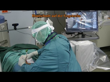 Smart Digital Navigation for Exact Placement of Pedicle Screws