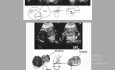Fetal Cervical Teratoma Prenatal Ultrasound Diagnosis