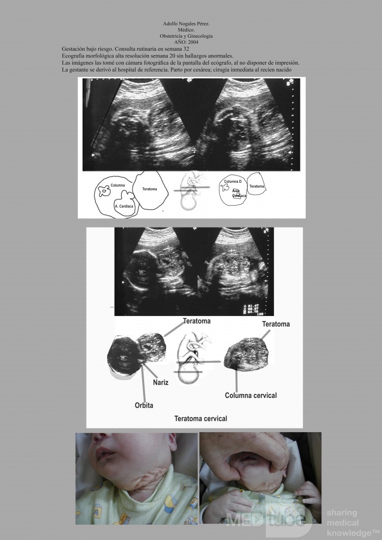 Fetal Cervical Teratoma Prenatal Ultrasound Diagnosis