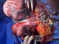 Huge Leiomyoma Uteri