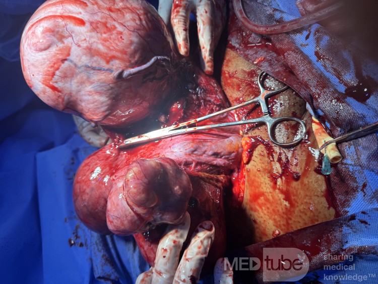 Huge Leiomyoma Uteri