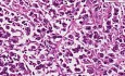 Dysgerminoma - Histopathology of ovary