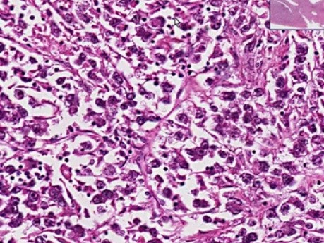 Dysgerminoma - Histopathology of ovary
